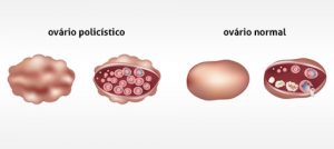 ovarios-policiticos